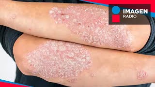 ¿Qué es y qué causa la Psoriasis [upl. by Frederiksen938]