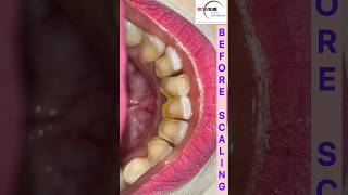 Teeth Cleaning by Doctor scaling teethcleaning dentist [upl. by Piscatelli]