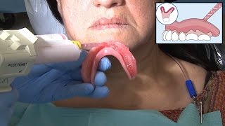 Clinical Demonstration Zest Chairside Soft Reline After Implant Placement [upl. by Addis304]