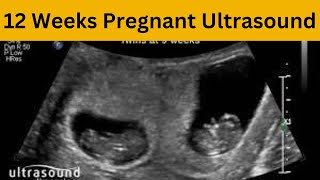 12 Week Ultrasound  12 Weeks Pregnant Ultrasound  12 Week Ultrasound 3d  12 Week Scan [upl. by Barnabe]