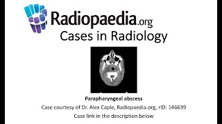 Parapharyngeal abscess Radiopaediaorg Cases in Radiology [upl. by Nosretep]