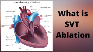 What is SVT Ablation [upl. by Jory]