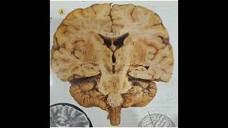 coronal section brain [upl. by Russ93]