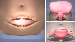 Abdominal Myomectomy through Maylard incision  TVASurg [upl. by Youlton]