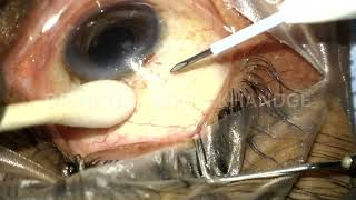 Ozurdex implant intravitreal injection technique [upl. by Christan]