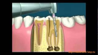 A gyökérkezelés menete [upl. by Etam]