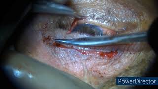 Levator Advancement for Aponeurotic Ptosis [upl. by Nnael]