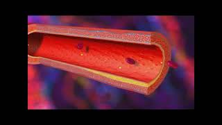 Infarctus du myocarde  IDM [upl. by Marlea]