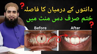 How to Close Gap Between Teeth Composite Bonding amp Veneers in Hindi  Urdu [upl. by James]