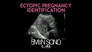 PointofCare Ultrasound for Ectopic Pregnancy Identification 5MS [upl. by Oilejor]