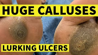 Huge Calluses Lurking Ulcers [upl. by Apfelstadt]