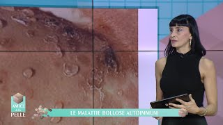 LE MALATTIE BOLLOSE AUTOIMMUNI [upl. by Emoryt]