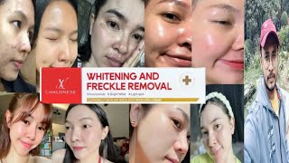 Chalonese Whitening Freckle Removal Cream  Honest Review [upl. by Odlanir904]