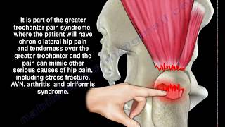 Gluteus Medius Tendon Tear  Everything You Need To Know  Dr Nabil Ebraheim [upl. by Hamaso]