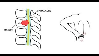 Spinal Cord Compression [upl. by Eneleh]