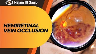 Hemiretinal Vein Occlusion With Macular Edema On Indirect Ophthalmoscopy [upl. by Bandur]