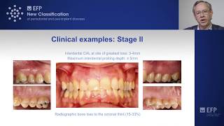 Assessing periodontitis clinical examples amp key points  tutorial by Mariano Sanz [upl. by Blasien]