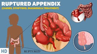 Ruptured Appendix What It Feels Like and How to Recognize the Symptoms [upl. by Nuahsar]