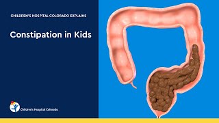 Pediatric Laxatives Senna vs PEG [upl. by Notxap]