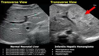 Pediatric Liver Gallbladder amp Bile Ducts Ultrasound Normal Vs Abnormal Images  Newborn amp Child USG [upl. by Valry]