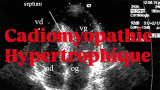 🫀CARDIOMYOPATHIE HYPERTROPHIQUE [upl. by Nais776]