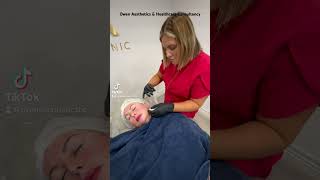 mesotherapy facial drpen dermatology dermalogicaskincare microneedling aesthetic [upl. by Mungam]