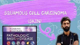 SQUAMOUS CELL CARCINOMA OF SKIN PATHOLOGY ROBBINS BASIS [upl. by Rehpinej]