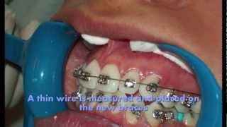 How braces are put on teeth 2012 [upl. by Eneja]