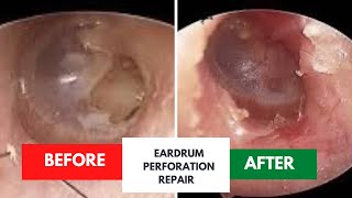 Successful repair of eardrum perforation [upl. by Artair]