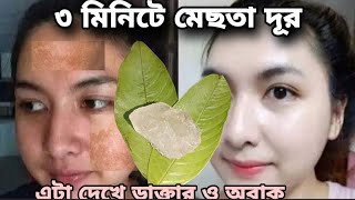 ১ রাতেই মেছতার দাগ দূর করার সহজ উপায়পুরাতন মেছতার দাগ চামড়ার ভিতর থেকে উঠে যাবেpigmentation [upl. by Laure221]