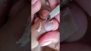 cleaning toenail ingrown videos pedicure subcribe satisfying [upl. by Nicolina]