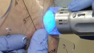 New Laser Treatment Approved for Psoriasis [upl. by Pelligrini]