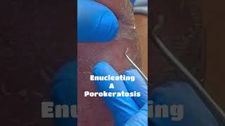 Enucleating A Porokeratosis [upl. by Elik]