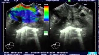 Gastric Cancer Staging by Endoscopic Ultrasound  Contrast Enhancement and RealTime Elastography [upl. by Bathsheb]