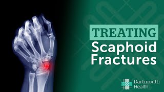 Treating Scaphoid Fractures at Dartmouth Health [upl. by Sirahs]