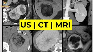 Imaging of Renal Masses ALL YOU NEED TO KNOW  Dr Daniel J Kowal RadiologistHQ [upl. by Edva]