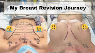 My Breast Augmentation Revision Journey with Dr Benoit Leblanc [upl. by Ensign906]