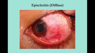 Scleritis and Episcleritis CRASH USMLE Step 2 and 3 [upl. by Lothar532]