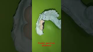 fixed partial dentureacrylic facing metal capviral videoshort videodentaltreatment dental [upl. by Ikiv]