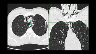 Pneumomediastinum [upl. by Vanni]