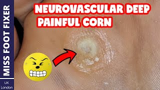 Neurovascular DEEP PAINFUL Corn Removal  Full Thickness Corn  BY MISS FOOT FIXER [upl. by Odysseus]