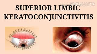 Superior limbic keratoconjunctivitis management  Punctate keratitis treatment keratoconunctivities [upl. by Dnomhcir]