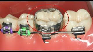 Molar Bands What they are and how they Work orthodontics [upl. by Nevah]