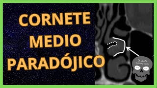 CORNETE Medio PARADÓJICO 👉Así se ve en TOMOGRAFÍA [upl. by Kanor]