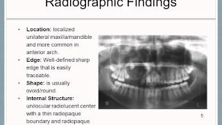 Adenomatoid Odontogenic Tumor [upl. by Biddy]