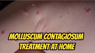 Molluscum contagiosum Treatment At Home [upl. by Glick712]