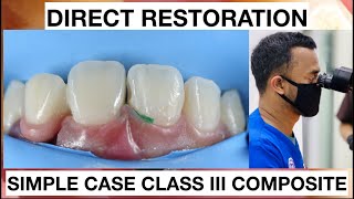 Dental Filling Procedure Class III Composite  General Dentist Griya RR [upl. by Eahs]