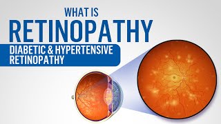 What is Retinopathy  Diabetic retinopathy  Hypertensive retinopathy [upl. by Adleme]