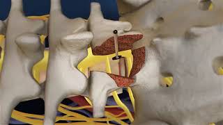 Lumbar Fusion of L5 S1 Animation TLIF Spine Fusion  DR SHASHIDHAR B K [upl. by Sura]