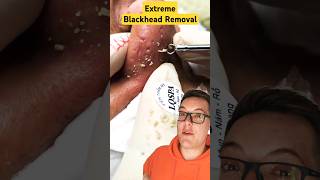 WOW Extreme BLACKHEAD REMOVAL  So Many Blackheads shorts [upl. by Ilam71]